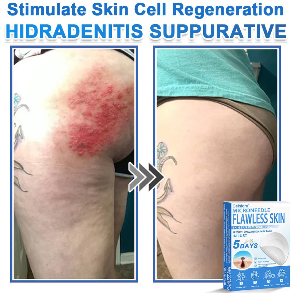 🔥 Celsiora® 2-in-1 Microneedle & Hydrocolloid Patch | Raised Moles,Acne,  Flat Warts & Skin Tags Remover | Improves Wrinkles, Scars & Blemishes | Invisible Pimple Patches for Face & Body