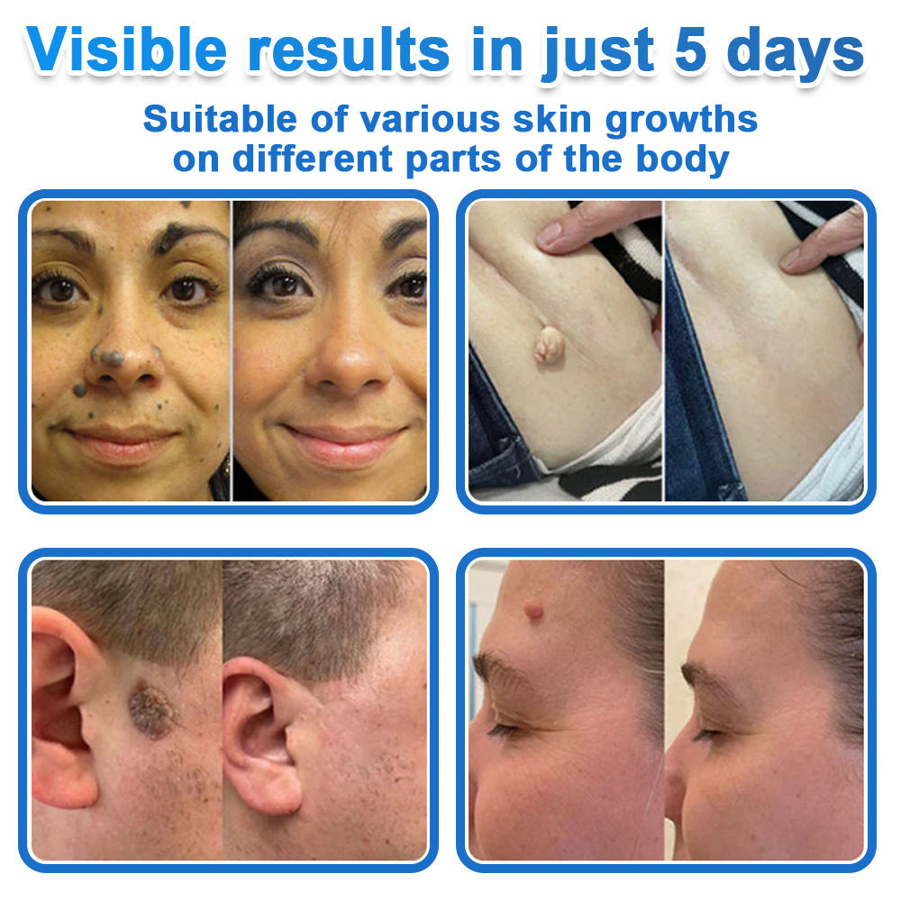 🔥 Celsiora® 2-in-1 Microneedle & Hydrocolloid Patch | Raised Moles,Acne,  Flat Warts & Skin Tags Remover | Improves Wrinkles, Scars & Blemishes | Invisible Pimple Patches for Face & Body