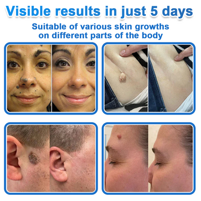 🔥 Celsiora® 2-in-1 Microneedle & Hydrocolloid Patch | Raised Moles,Acne,  Flat Warts & Skin Tags Remover | Improves Wrinkles, Scars & Blemishes | Invisible Pimple Patches for Face & Body