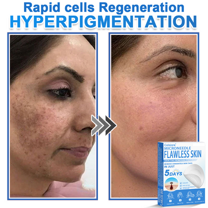 🔥 Celsiora® 2-in-1 Microneedle & Hydrocolloid Patch | Raised Moles,Acne,  Flat Warts & Skin Tags Remover | Improves Wrinkles, Scars & Blemishes | Invisible Pimple Patches for Face & Body