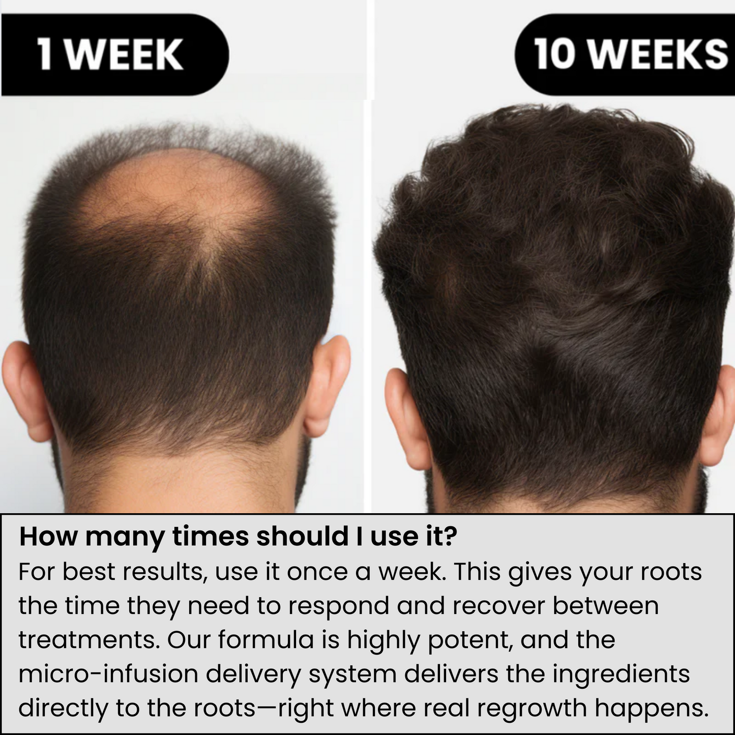 Fivora™ Hair Regrowth System