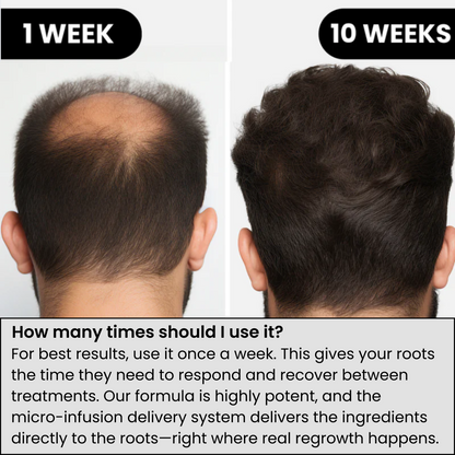 Fivora™ Hair Regrowth System