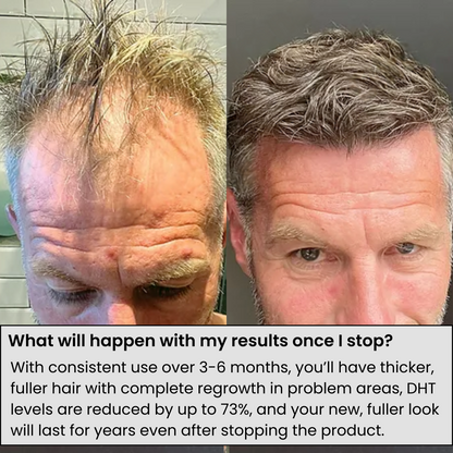 Fivora™ Hair Regrowth System